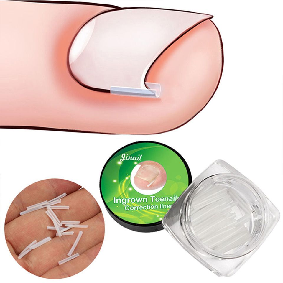 Ingrown Nail Correction C-Shaped Nail Groove Pads Cuttable Nail Orthotics Splint Brace Pain Relief Foot Care Tools